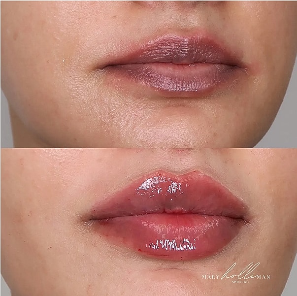 Before and after lip treatment comparison.